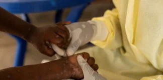 Brasil registra 140 casos de Mpox em 2026