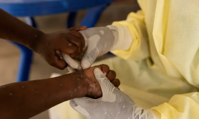 Brasil registra 140 casos de Mpox em 2026